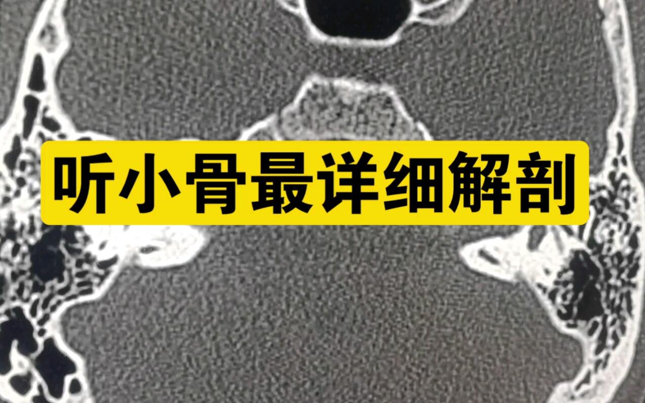 人体最小骨头—听小骨CT细微解剖,不要漏掉!耳聋,听力下降原因。反复听力下... - 哔哩哔哩