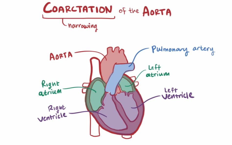 【搬运osmosis】Coarctation of the Aorta (CoA)哔哩哔哩bilibili