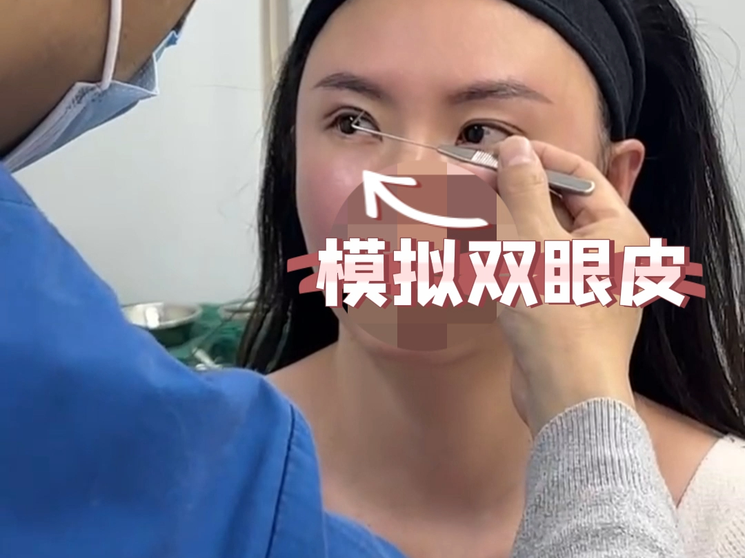 双眼皮手术术前模拟