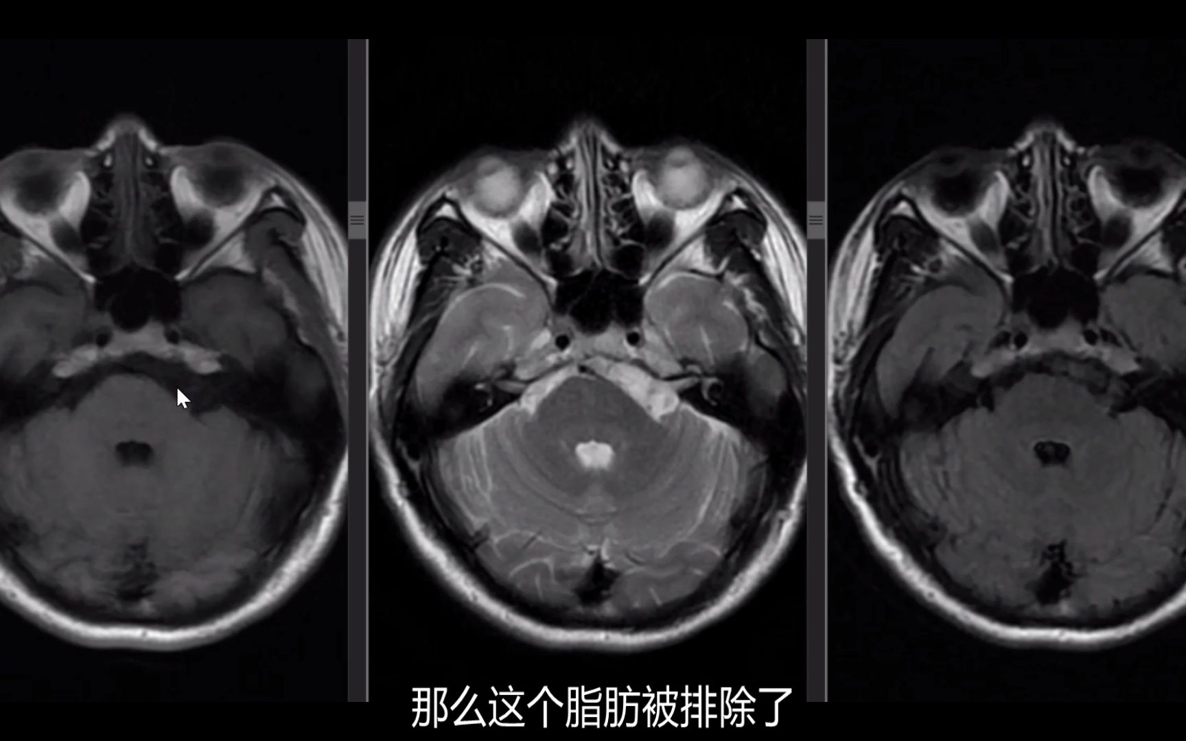 颅内表皮样囊肿的核磁信号讲解哔哩哔哩bilibili