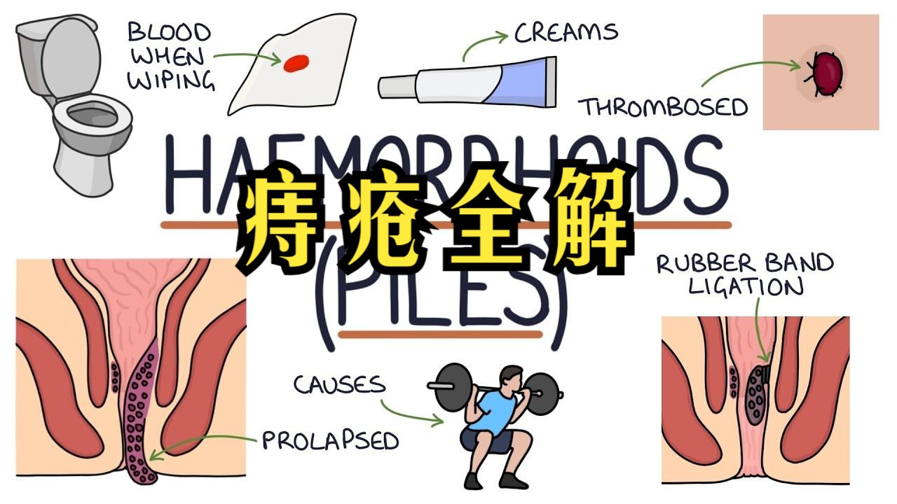 痔疮全解Understanding Haemorrhoids哔哩哔哩bilibili