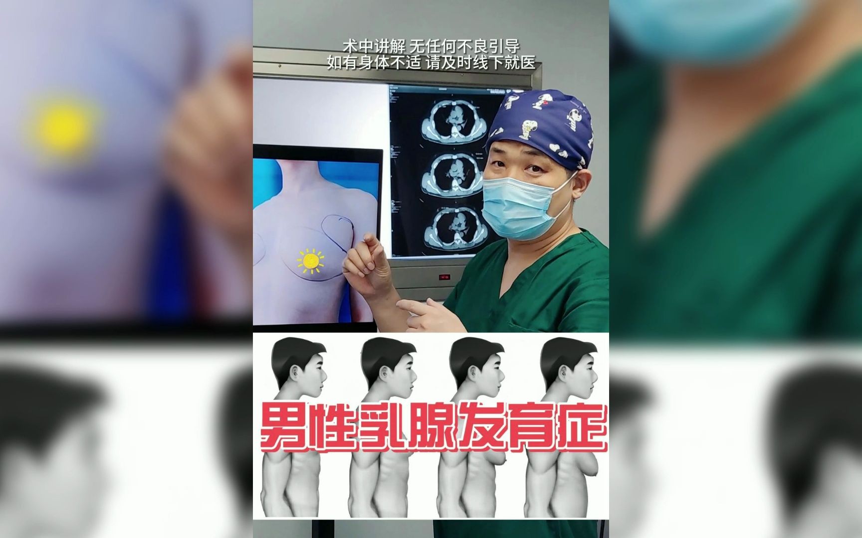 男士乳腺腺体增生图片