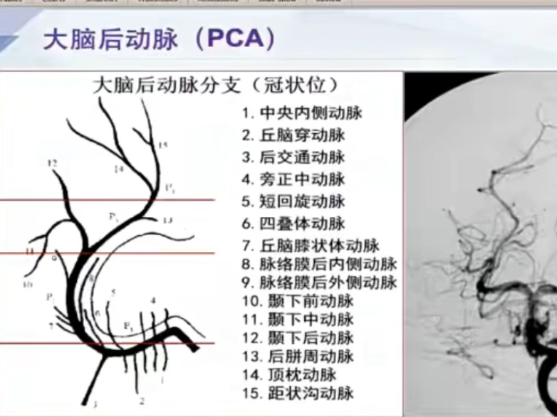 第六讲:大脑后动脉丘脑供血动脉血管解剖和造影解读曹文杰哔哩哔哩bilibili