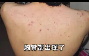 Tải video: NO67：后背好多红疙瘩 特别难看怎么办？