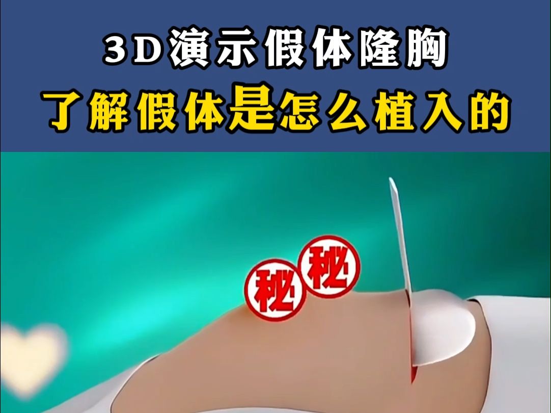 3D动画假体隆胸,来看看假体是怎么植入的吧哔哩哔哩bilibili