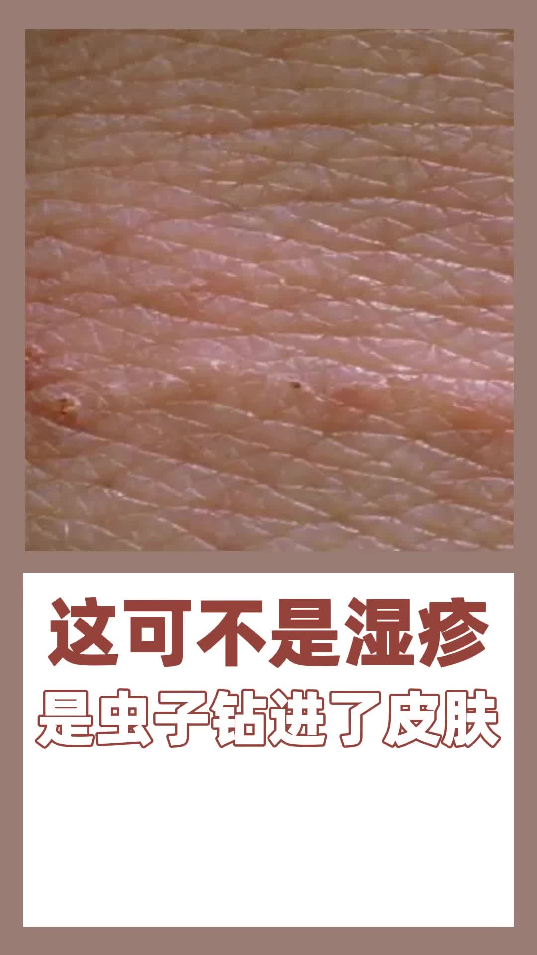 这可不是湿疹,是虫子钻进了皮肤