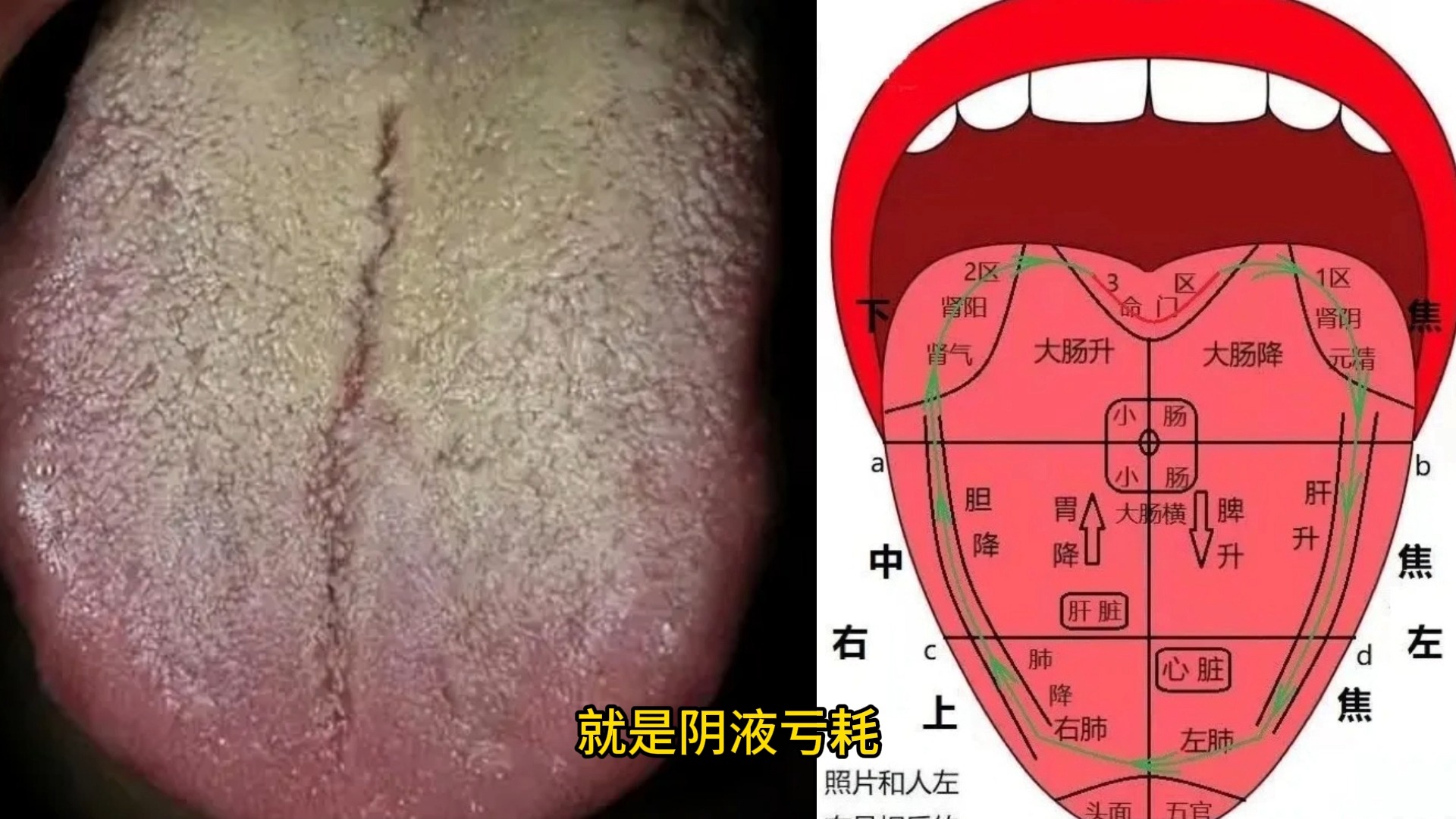 舌裂是怎么回事图片