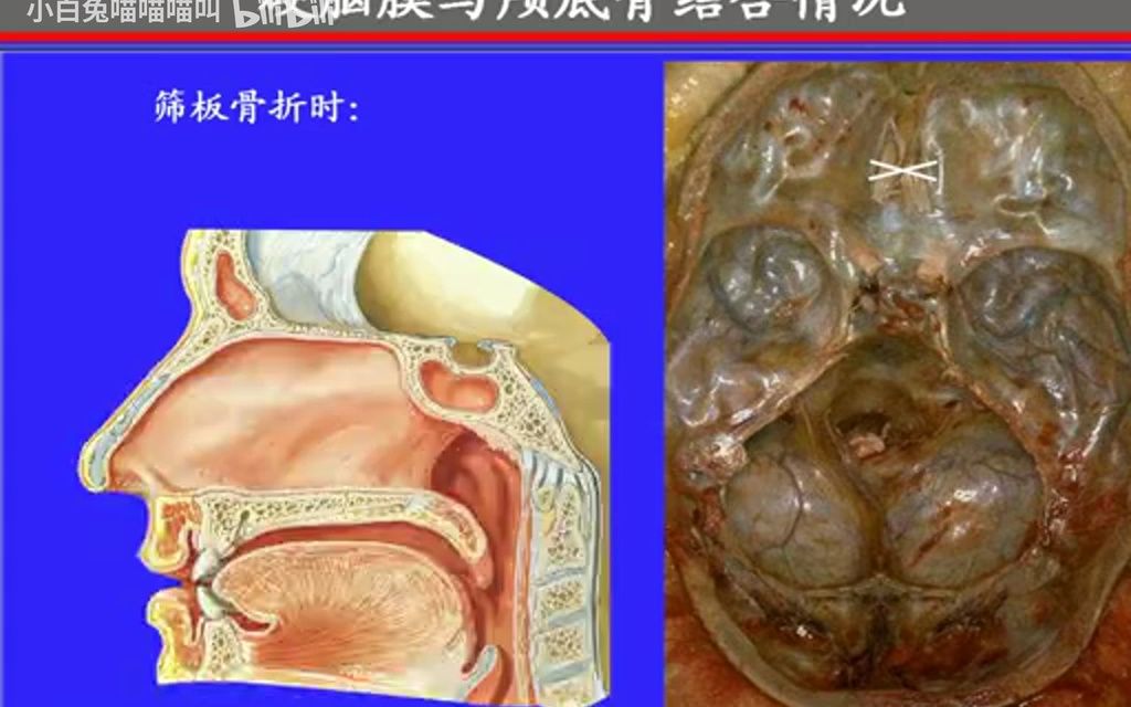 169.脑被膜——系统解剖学、局部解剖学——这一套就够了哔哩哔哩bilibili