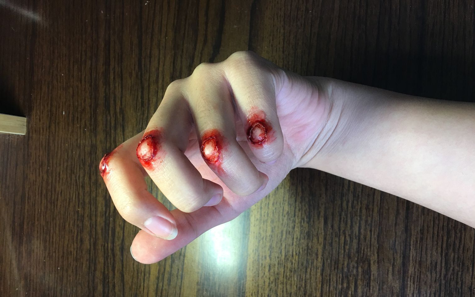 指关节擦伤(严重)part2