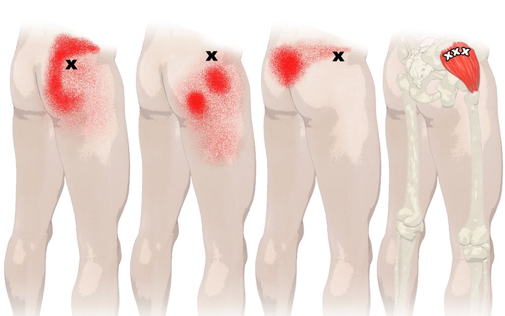 臀中肌 | 稳定骨盆的核心肌肉,也是调理腰膝疼痛不能忽略的肌肉!
