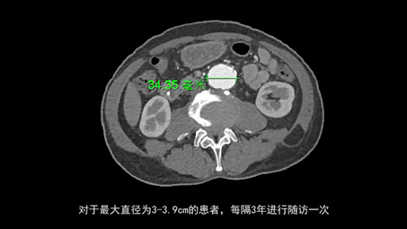 [图]《全身CT血管成像诊断学第2版》高清带书签(含随书视频）：08腹主动脉瘤CT血管成像检查和诊断要点