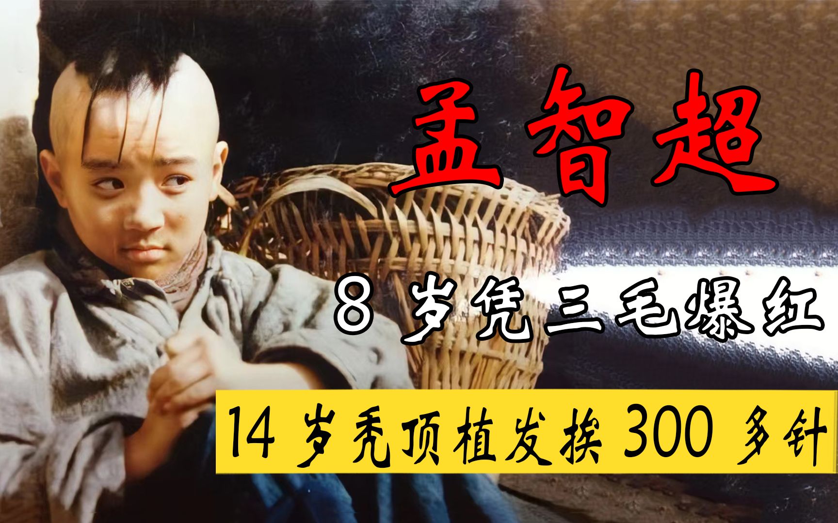 8岁凭三毛爆红,14岁秃顶植发挨300多针,如今的孟智超怎样了?哔哩哔哩bilibili