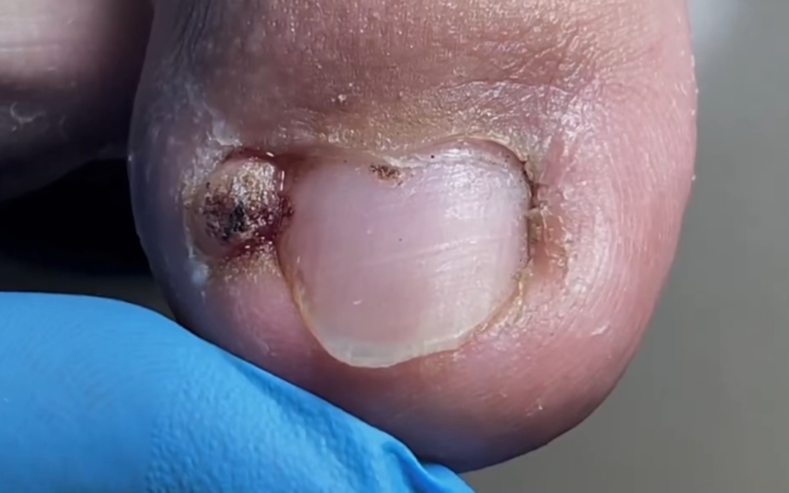 连指甲带息肉,全部铲除干净