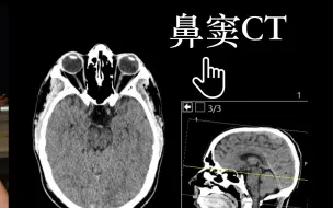 Download Video: 【影像】【解剖】鼻窦CT（Paranasal sinuses CT）