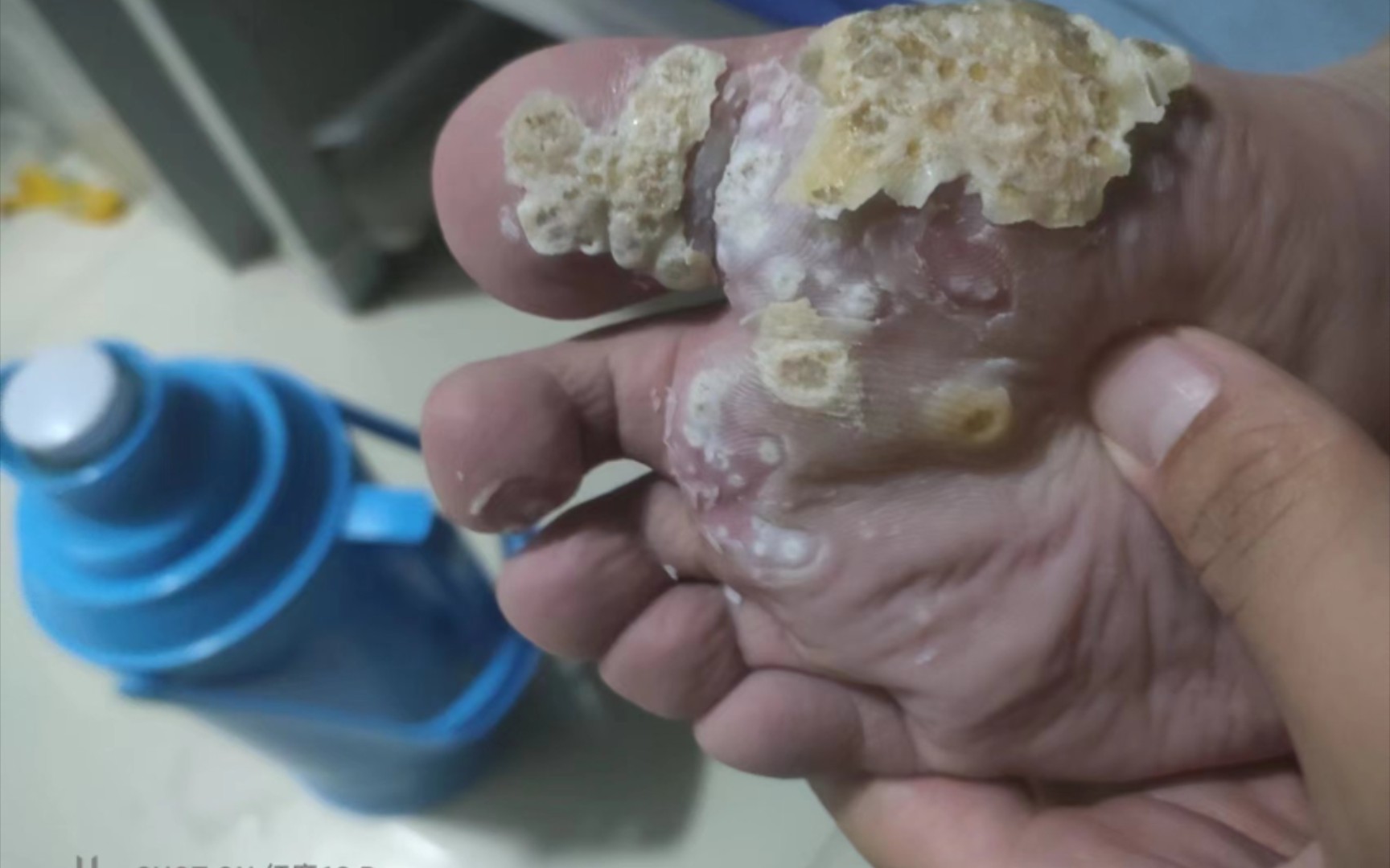 群发性跖疣涂抹脱落过程太解压了吧