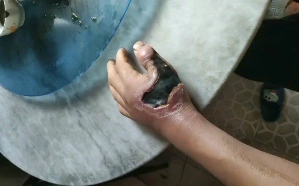 五步蛇咬伤太可怕了,具体严重到烂肉需要截肢,这才是可怕之处!