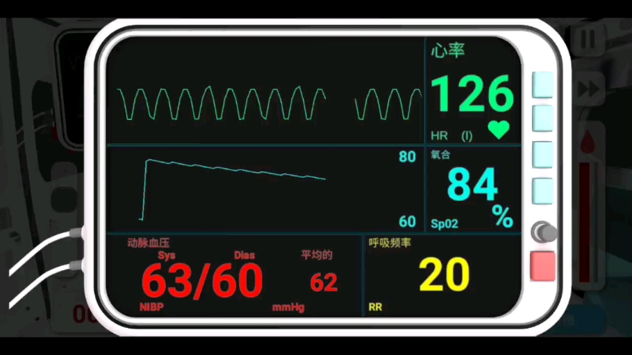 康复公司:真实医疗模拟器 病人死亡全过程(心室扑动—失去意识—心室