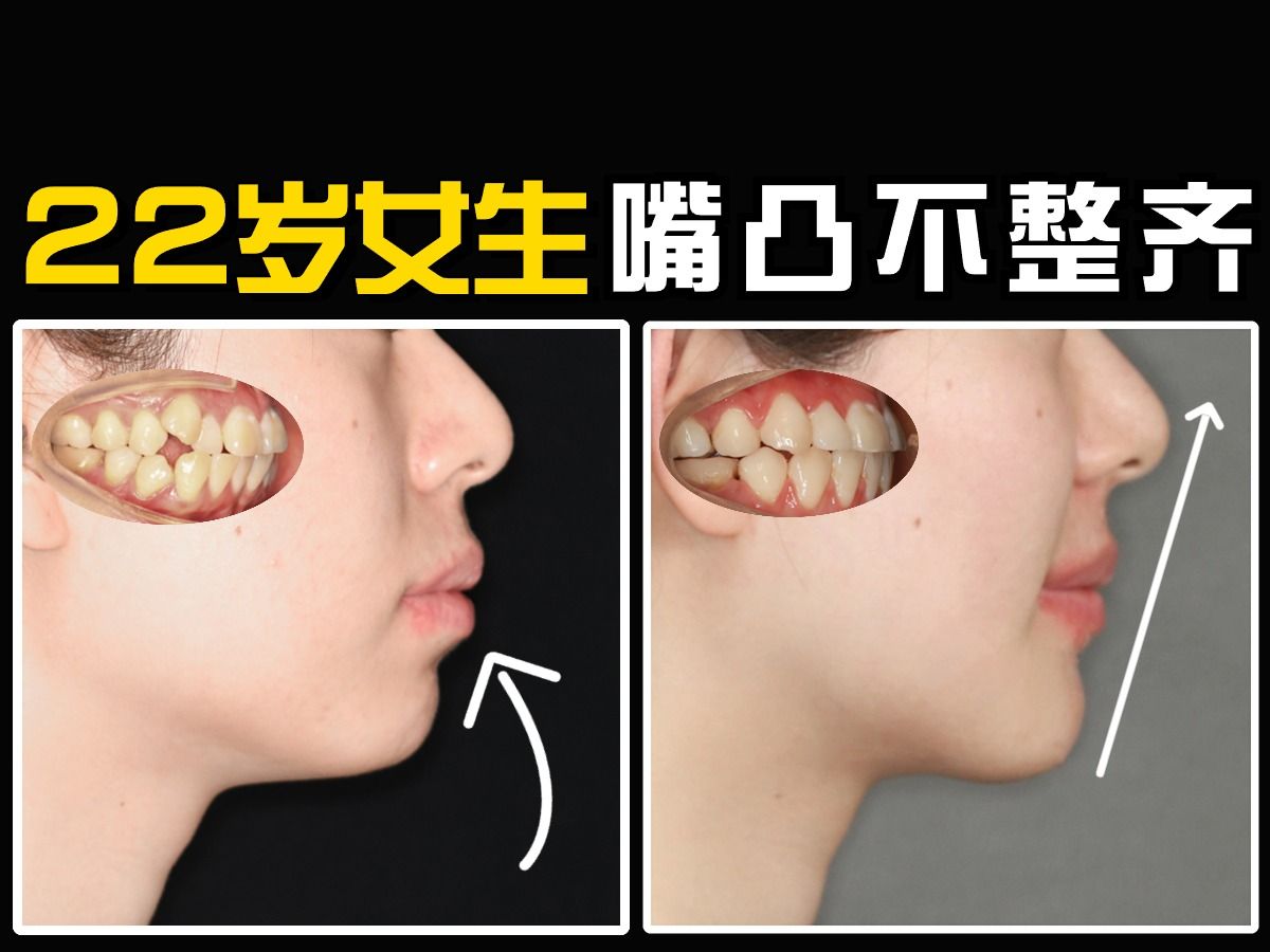 嘴巴突出怎么改善图片