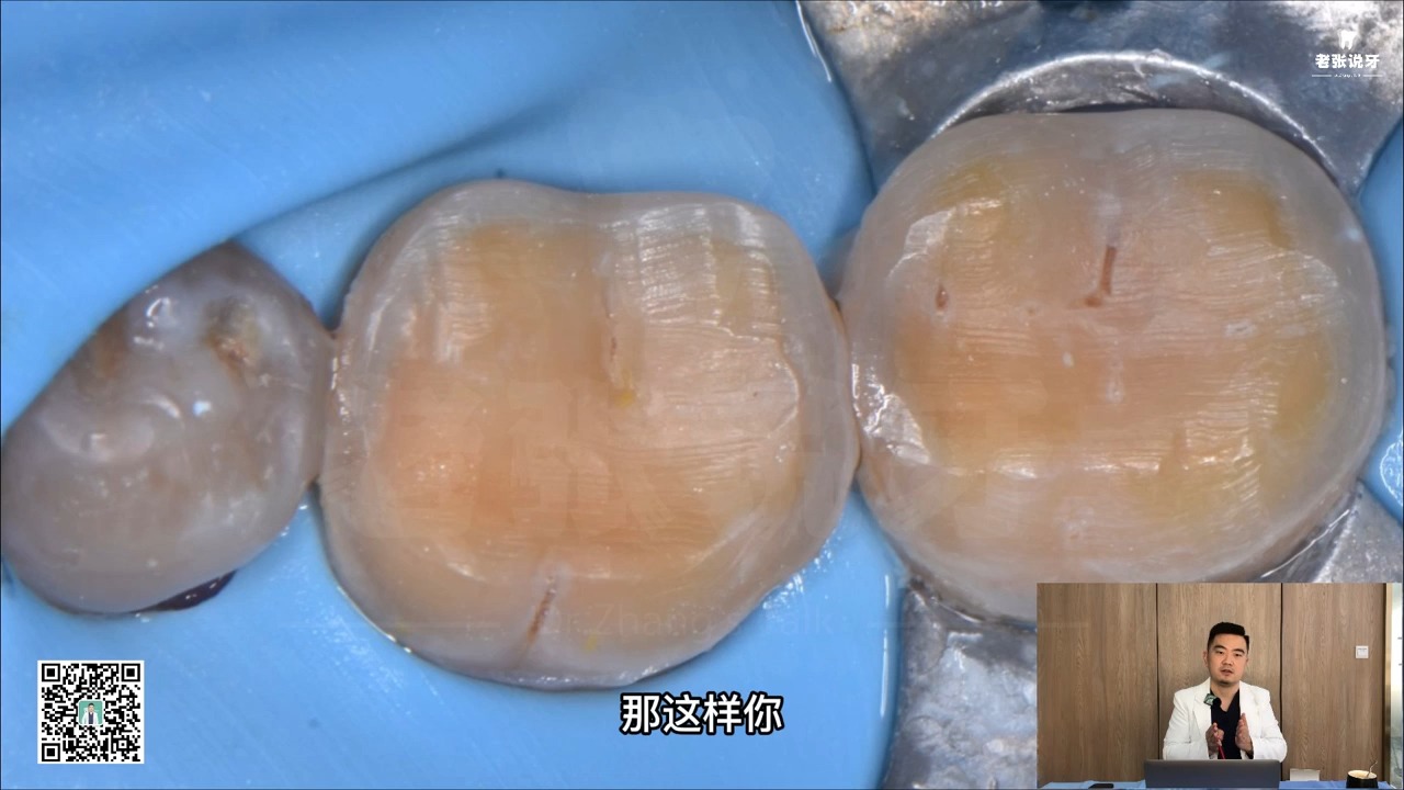 后牙嵌体预备嵌体设计理论 1-1