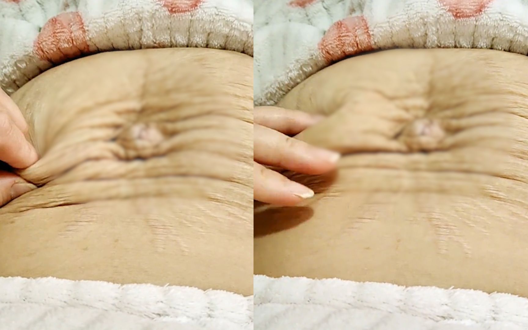 女子晒产后2年的肚子,皮肤皱巴干瘪没什么弹性:每次看都会难过