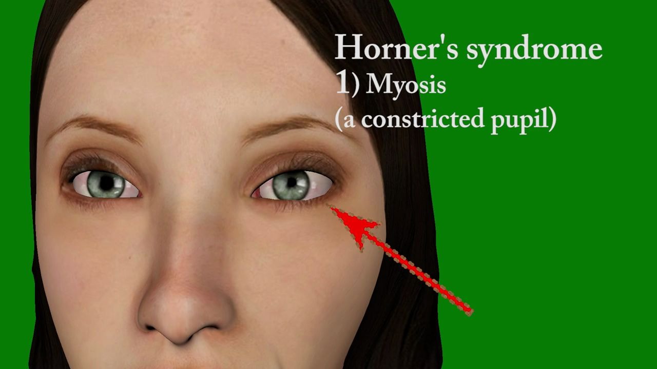 horner综合征临床表现图片