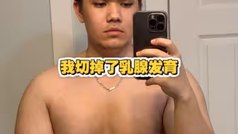 男性乳腺发育手术到底是不是智商税？我做完之后，有了答案