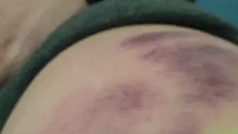 和着静心音乐拍痧，膝关节大腿不适好多啦