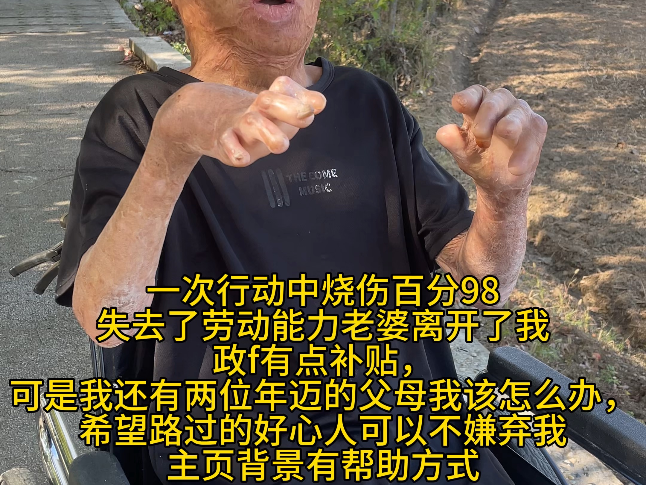 谢谢您刷到我没有划走 烧伤后失去劳动能力 无奈之下~来到网上做网络乞丐 您能给我点个关注吗哔哩哔哩bilibili