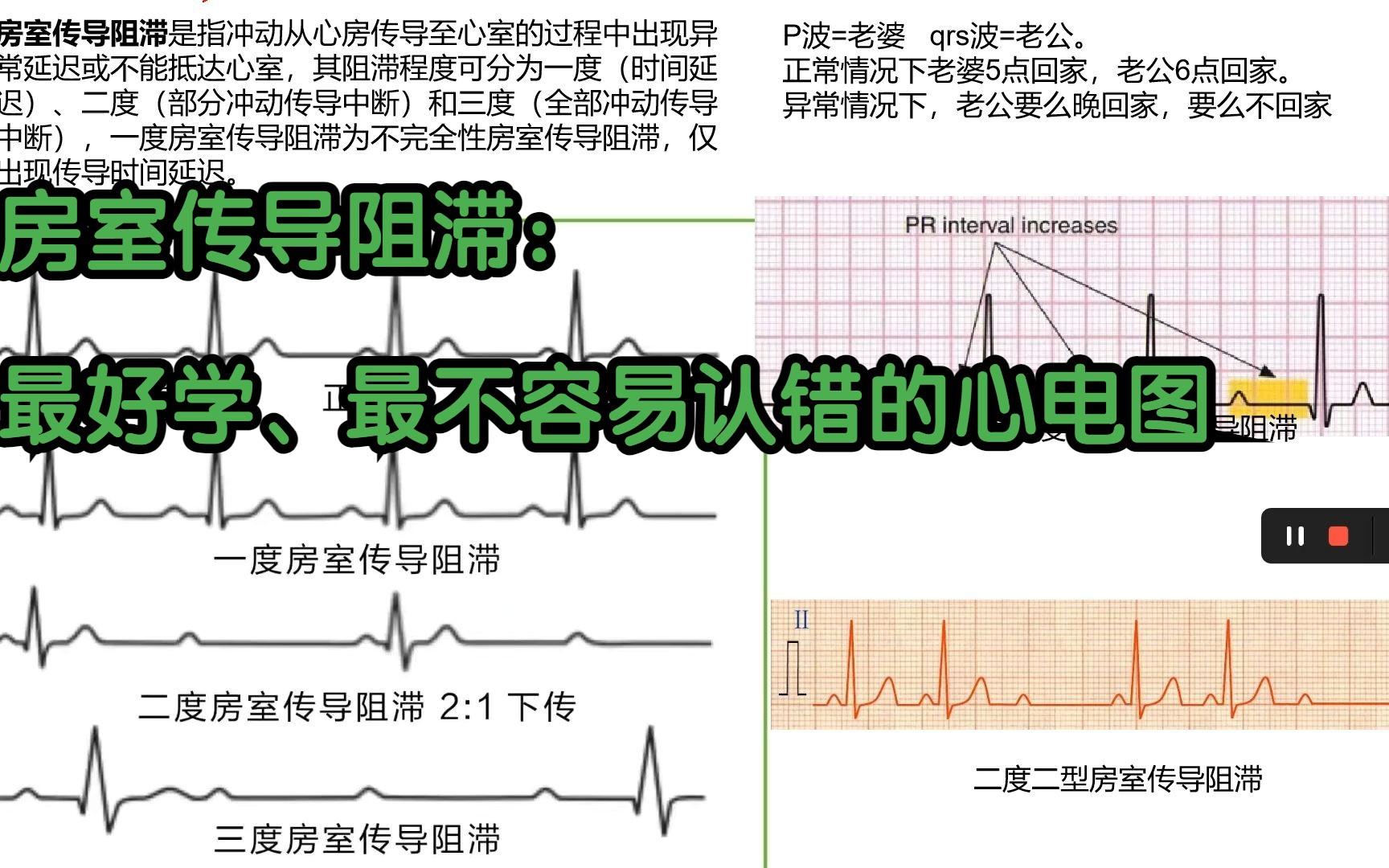 【心电图学习8】| 各种类型的房室传导阻滞 | 我愿称之为性价比最高的心电图:很快就可以学会,而且很不容易忘记哔哩哔哩bilibili