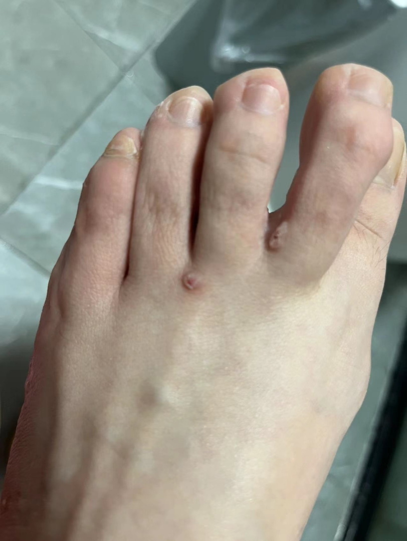 脚背寻常疣脱落过程太解压了吧