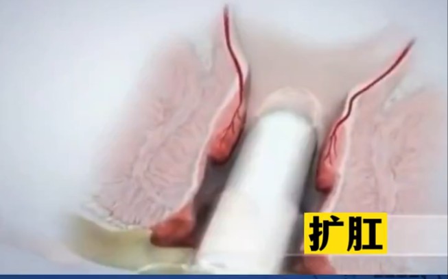 肛门镜检查过程-扩肛,看着都疼