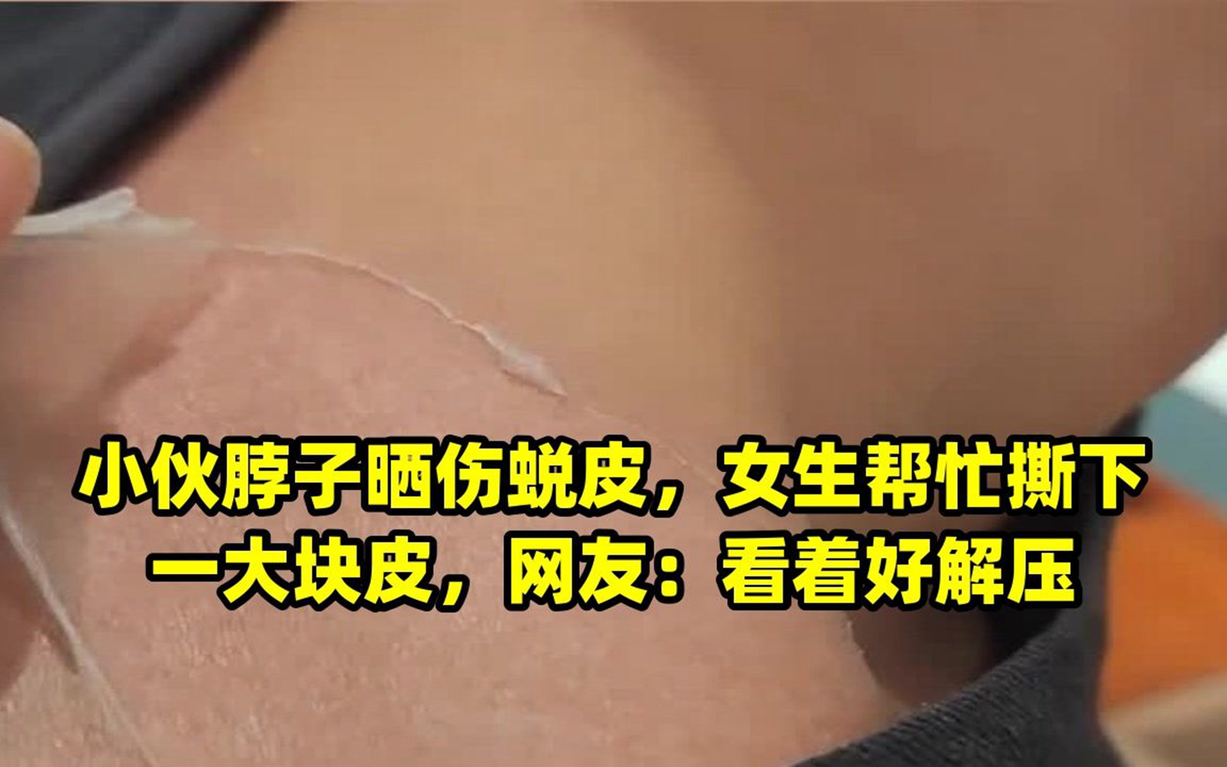小伙脖子晒伤蜕皮,女生帮忙撕下一大块皮,网友:看着好解压
