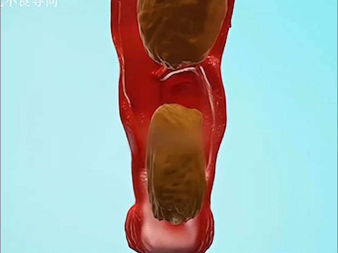 肠子里堵满大便,怎么用力都没用