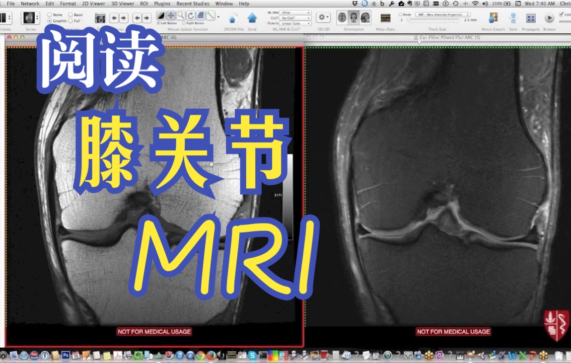 [图]如何阅读膝关节磁共振-Systematic Interpretation of Knee MRI- How I do it