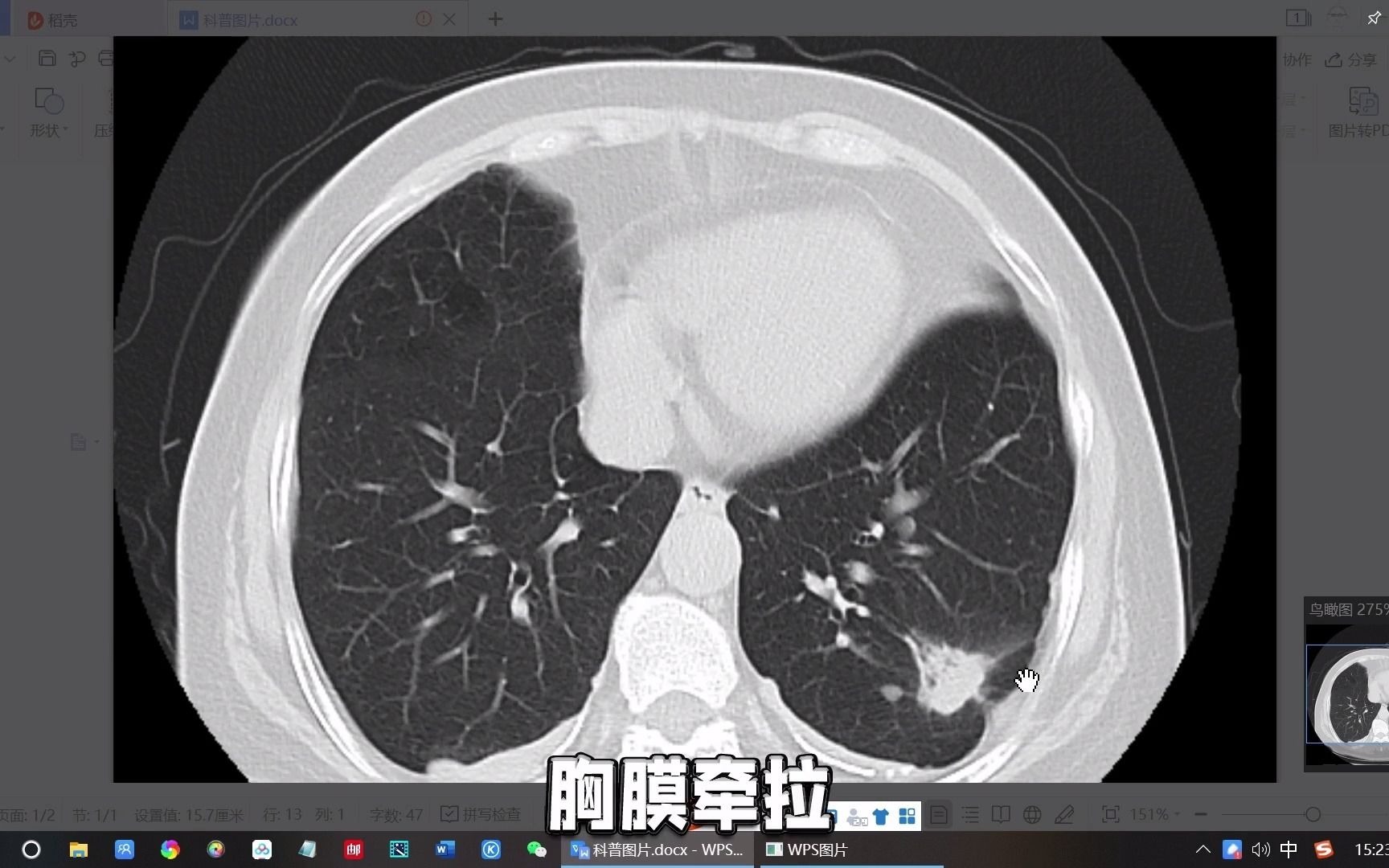 肺結節是惡性腫瘤的幼年兇惡本質已經顯現