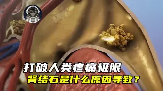 打破人类疼痛极限的肾结石，到底是什么原因导致的？