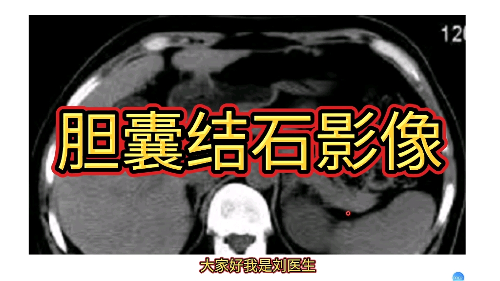 影像报告解读:胆囊结石CT表现!并不仅仅是高密度!哔哩哔哩bilibili