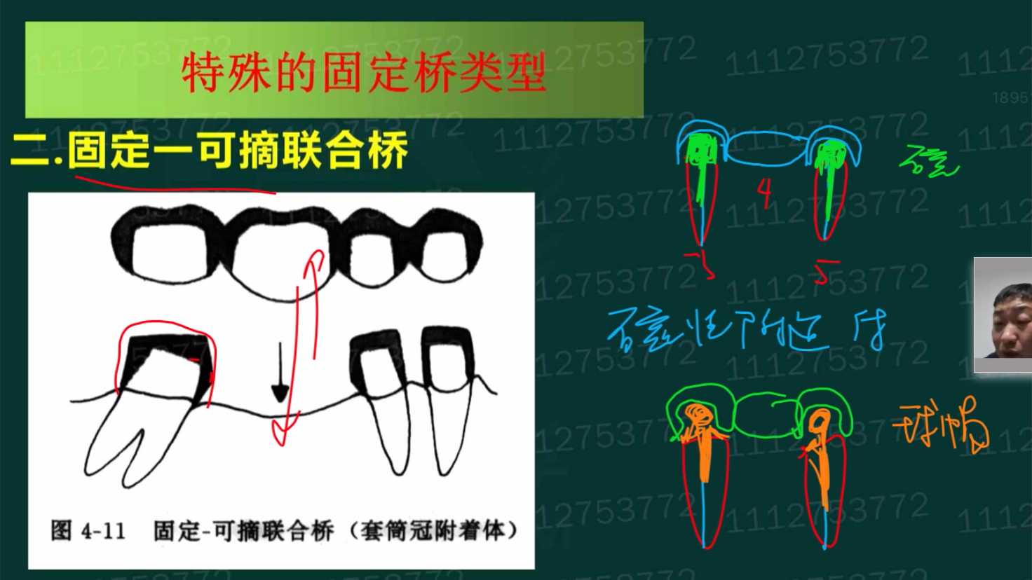 固定可摘联合桥图片