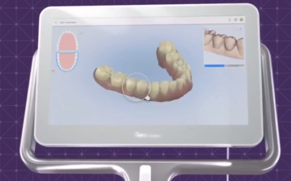 深圳牙齿矫正𐟌ˆiTero口扫|口扫有什么作用?哔哩哔哩bilibili
