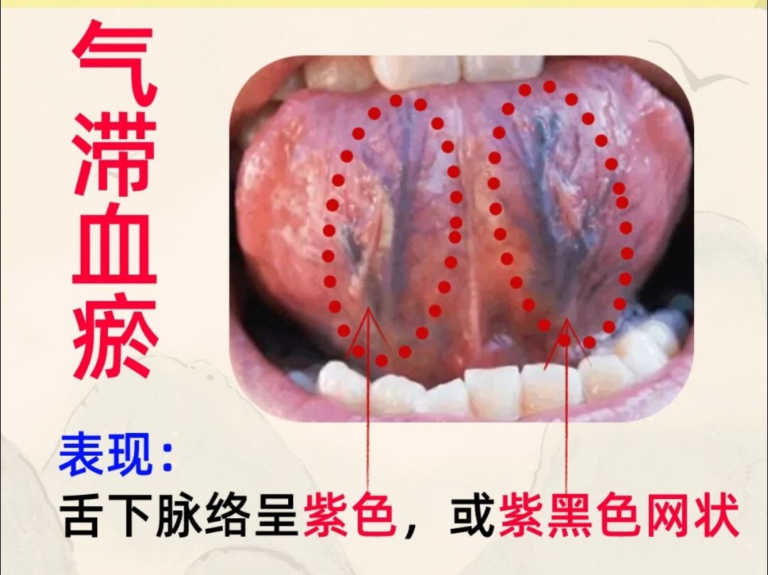 身体哪有瘀堵,看看舌下就知道!4种瘀堵对照一下你是哪种?哔哩哔哩bilibili