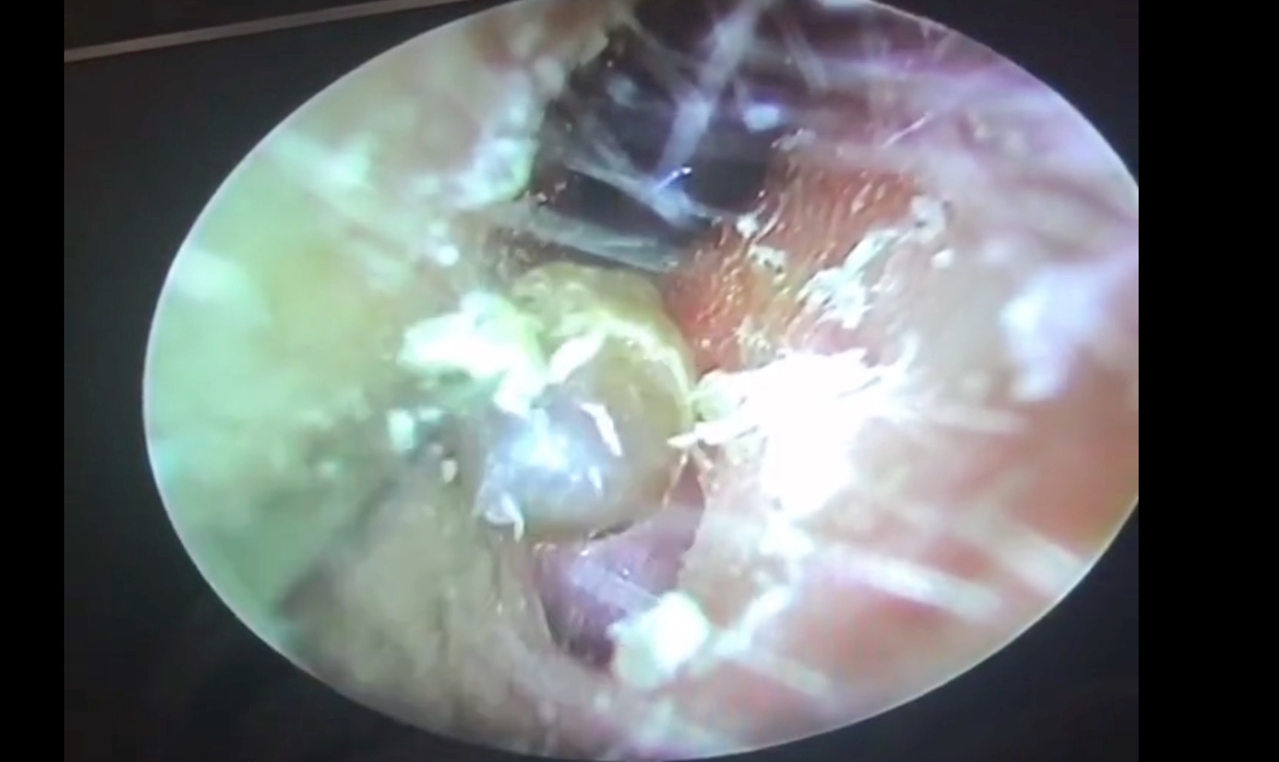 耳朵里的超级大黑头