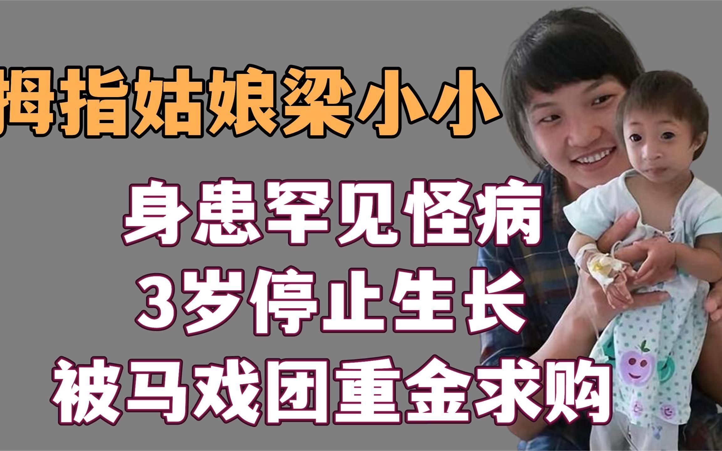 拇指姑娘梁小小:患罕见怪病,5岁体重才5斤,曾被马戏团重金求购哔哩哔哩bilibili