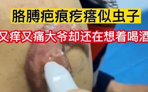 Скачать видео: 心可真大！胳膊上的疤痕疙瘩长成“虫子”，大爷却还在想着喝酒