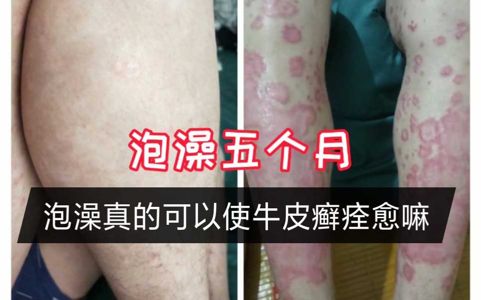 我每天泡澡和运动牛皮癣到底能不能治好
