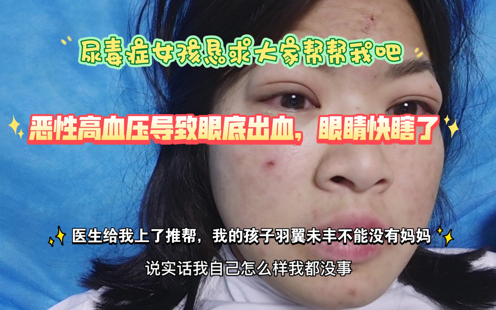 25岁尿毒症晚期女孩恶性高血压导致眼底出血,眼睛快瞎了,第一次恳求