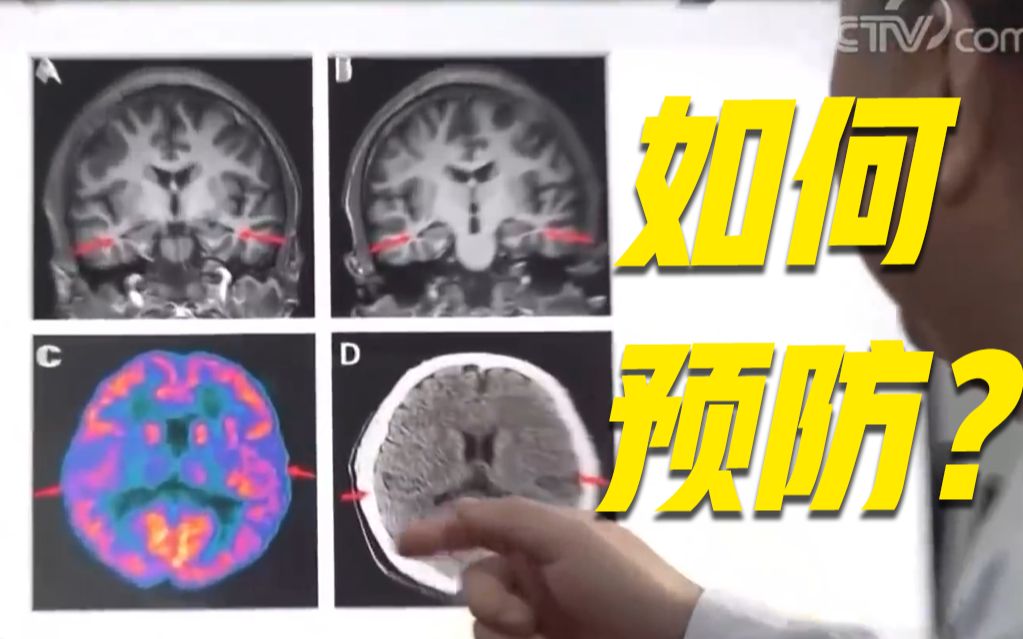 [图]19岁男孩确诊阿尔茨海默病 健忘是患病的前兆吗？