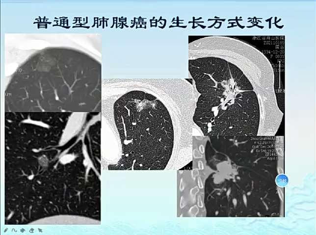 肺结节的病理影像学哔哩哔哩bilibili