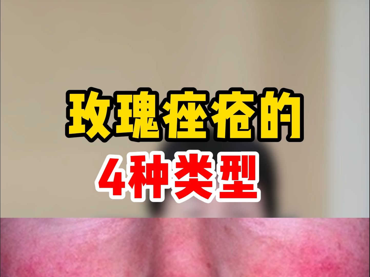 玫瑰痤疮的四种类型