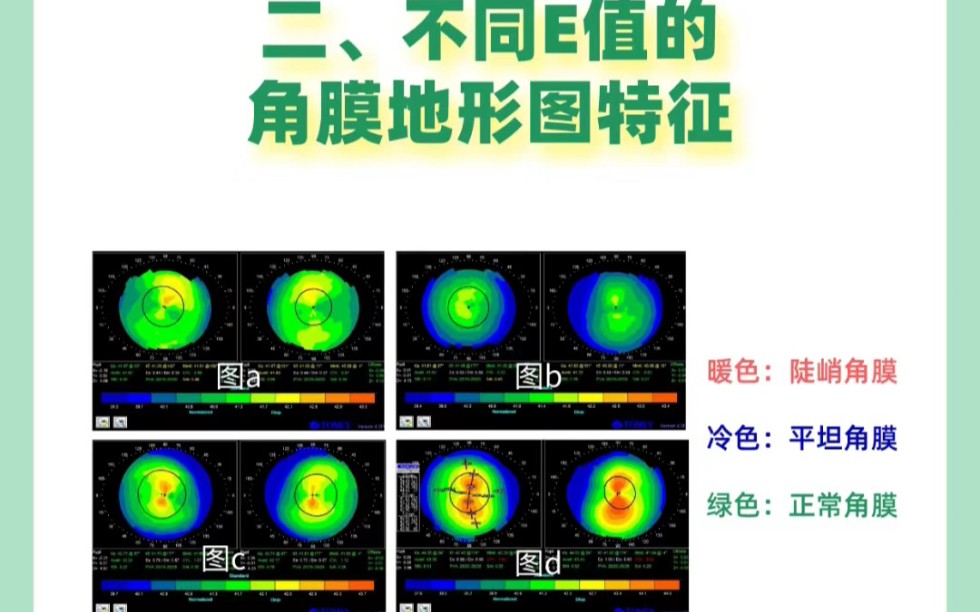 配角膜塑形镜(OK镜)时看的E值是什么?哔哩哔哩bilibili