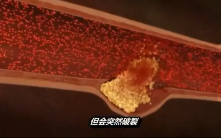 动脉斑块破裂促使血栓堵塞引发心肌梗塞，动画展示全过程，终于明白为什么血管会堵了！
